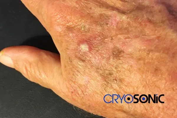 Book Your Actinic Keratosis removal High Wycombe treatment Today High Wycombe