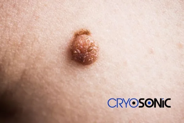 Are you looking for local Dermatofibroma Removal Bristol? Contact our team today in High Wycombe