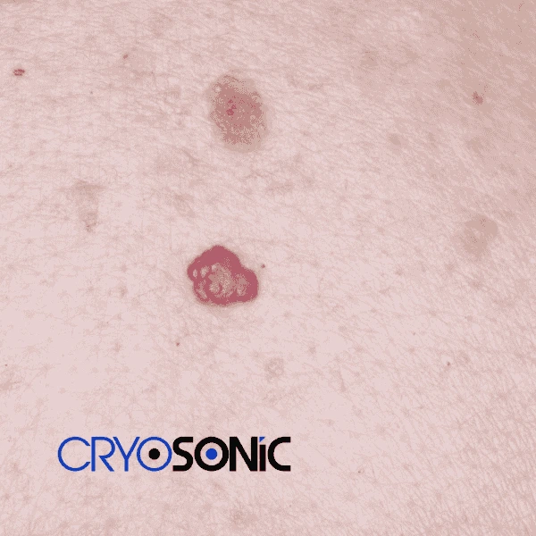 Looking for pain free cherry angioma removal treatment High Wycombe? Call our team today! High Wycombe