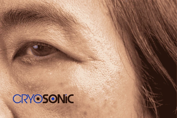 Start age spots removal High Wycombe treatment today! Call our team now! High Wycombe