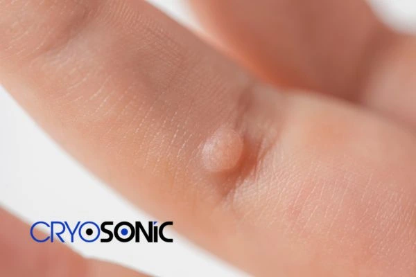 Contact Cryosonic today to learn more about us High Wycombe now! High Wycombe