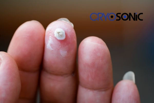 Learn more about us High Wycombe at Cryosonic. Book in today! High Wycombe