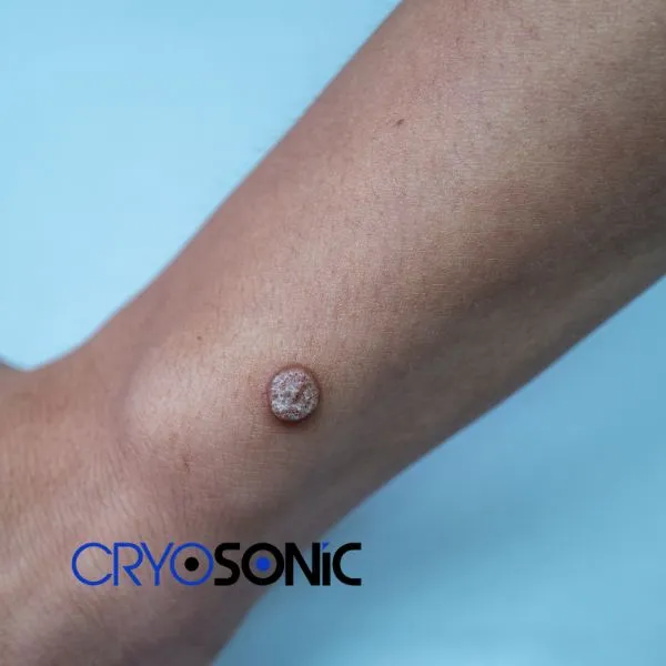 Deep Verrucae removal treatment possible from your own home! Book treatment today High Wycombe