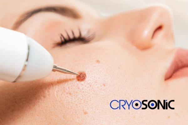 why choose us at Cryosonic for blemish removal? Find out more now High Wycombe