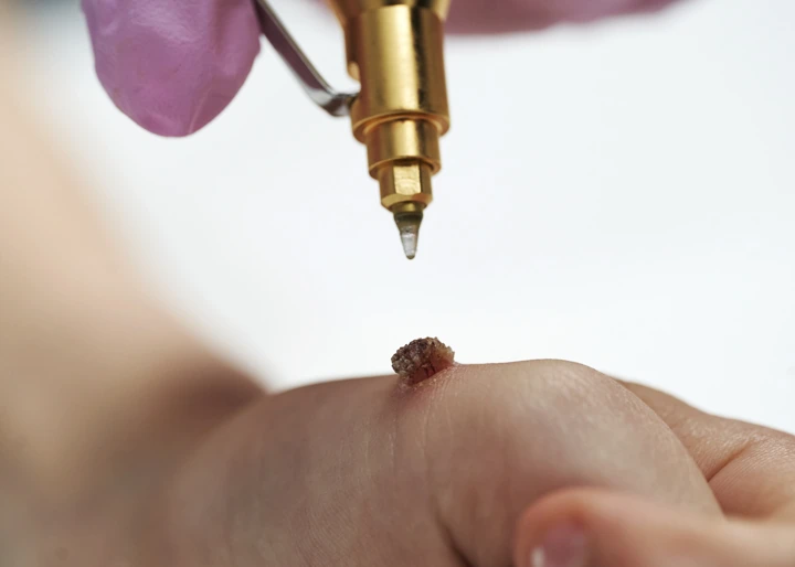 Cryopen For Children Bristol High Wycombe