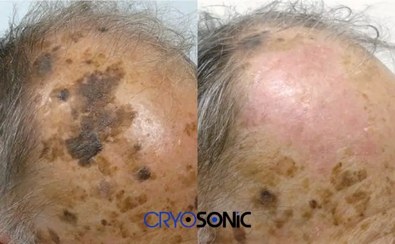 Seborrhoeic Keratosis Removal before and after High Wycombe