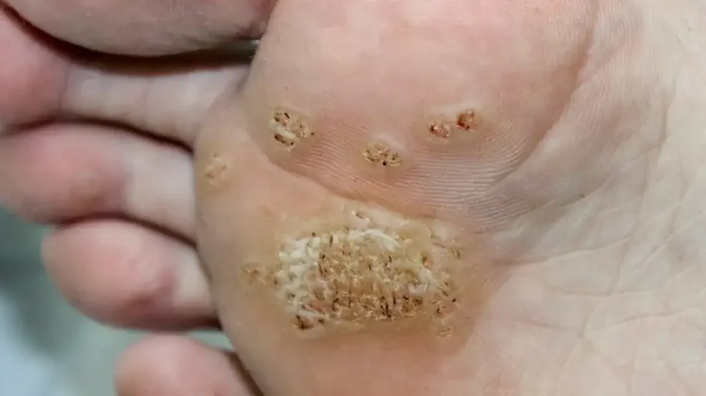 Secure Your Wart Removal Appointment with One Click High Wycombe