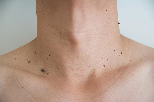 What to Avoid After Benign Mole Treatment in High Wycombe High Wycombe