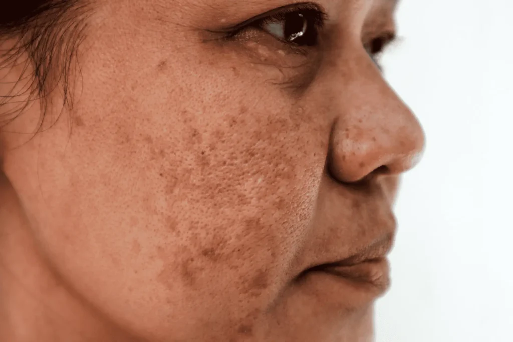 Aftercare Advice for Sun Damage Treatment High Wycombe