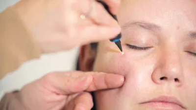 Aftercare Advice Following Milia Removal in High Wycombe