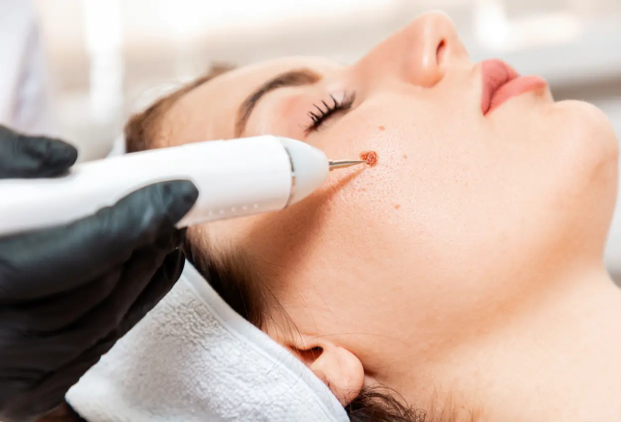 Frequently Asked Questions About Multiple Cryotherapy Treatments High Wycombe