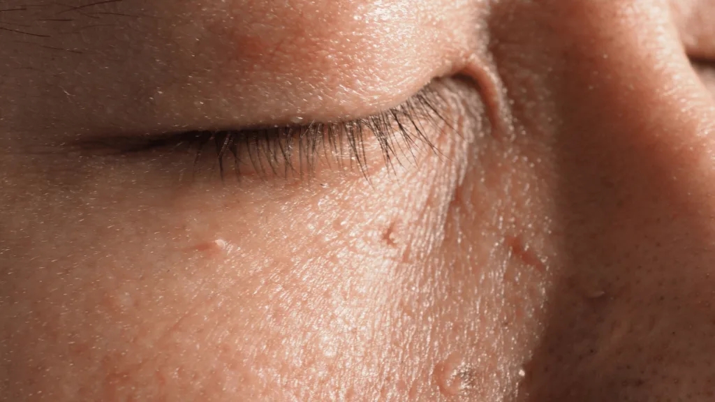 Frequently Asked Questions about Skin Tag Removal High Wycombe