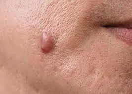 Skin Tags Recovery Time and Skin Healing Expectations High Wycombe