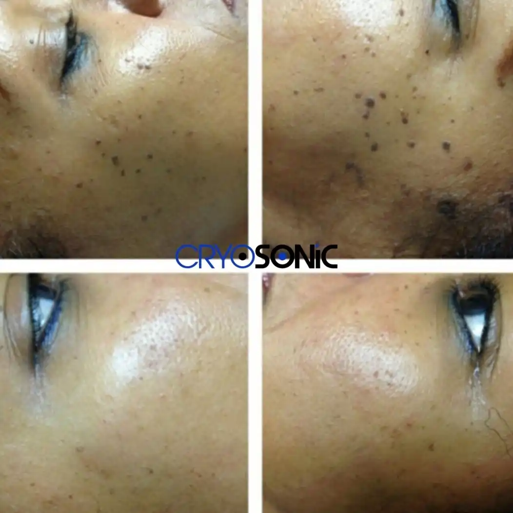 Why Skin Shows Pigmentation After Treatment High Wycombe