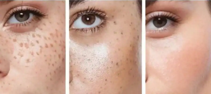 Ephelides Removal Results and Healing Timeline High Wycombe