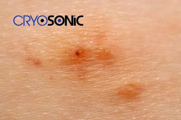 Image of Molluscum Contagiosum Treatment High Wycombe High Wycombe