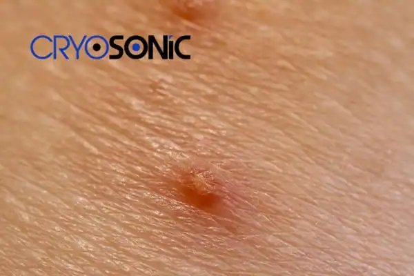 Molluscum Contagiosum Treatment High Wycombe High Wycombe