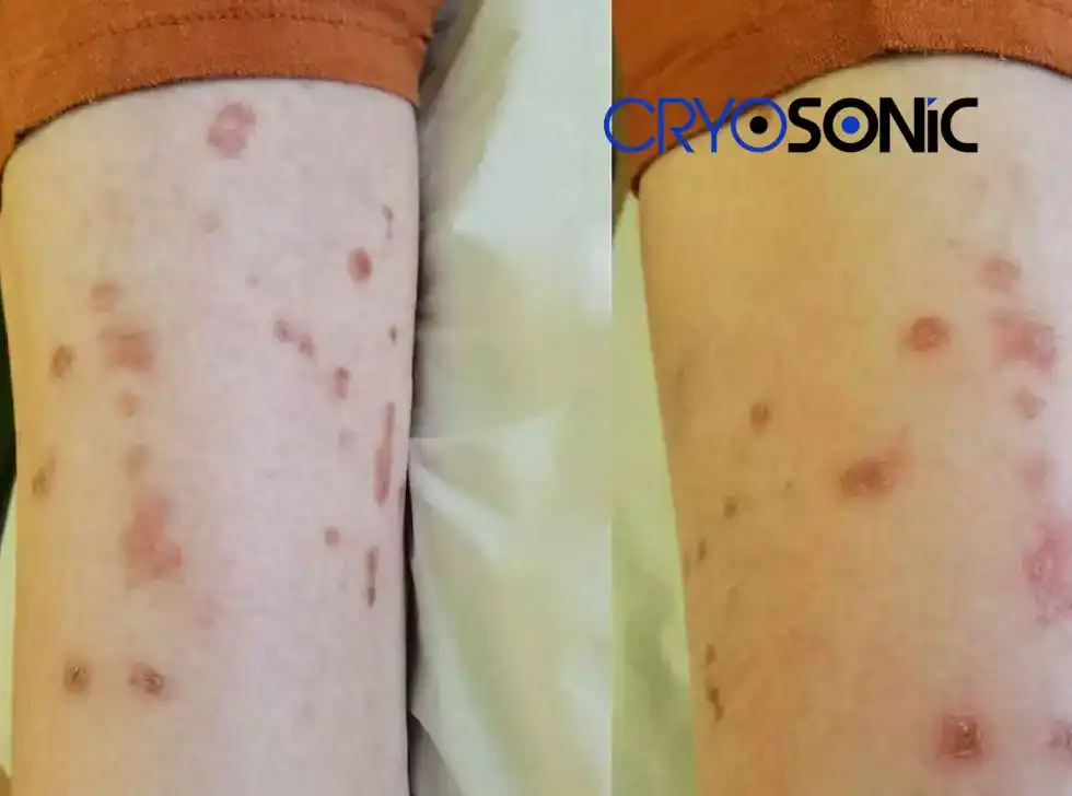 Recovery and Aftercare for Porokeratosis Treatment High Wycombe High Wycombe
