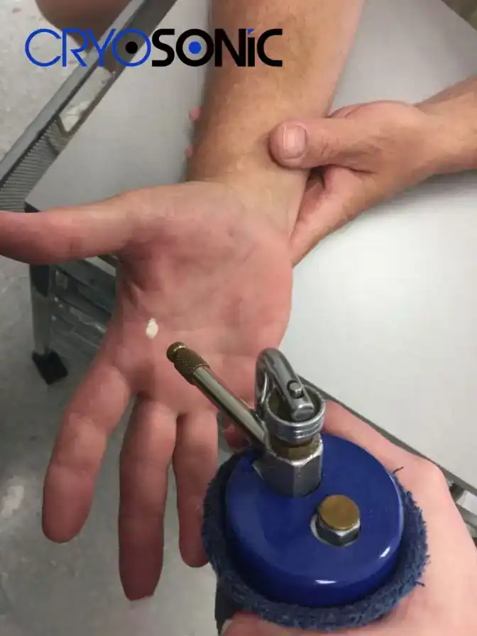 Temperature Differences: OTC vs Medical-Grade Cryotherapy High Wycombe